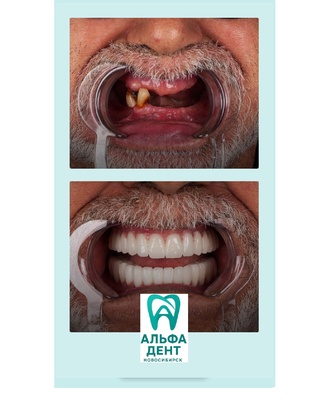 f98e9b91-c646-486f-9793-918f6eb06640-alfadent.jpg