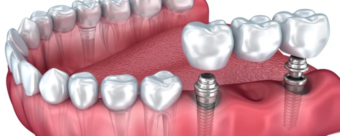 Зубной имплант — 