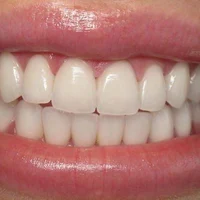 Фторирование  зубов